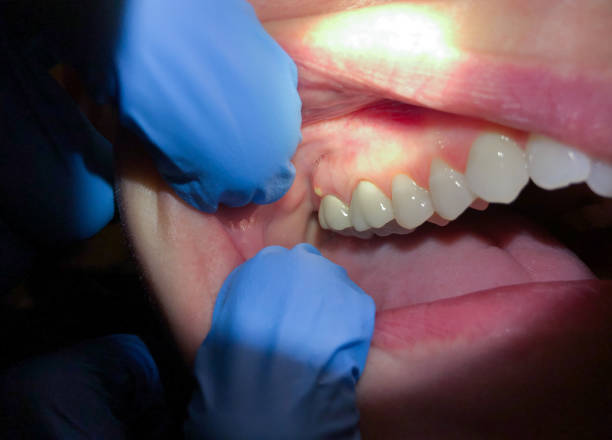 Best Emergency Denture Repair in Colfax, LA